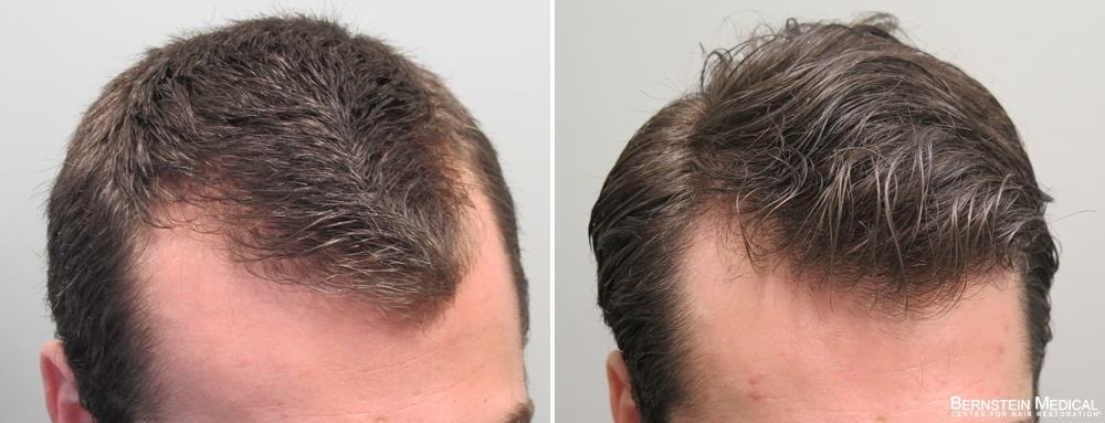 does finasteride work for hair loss