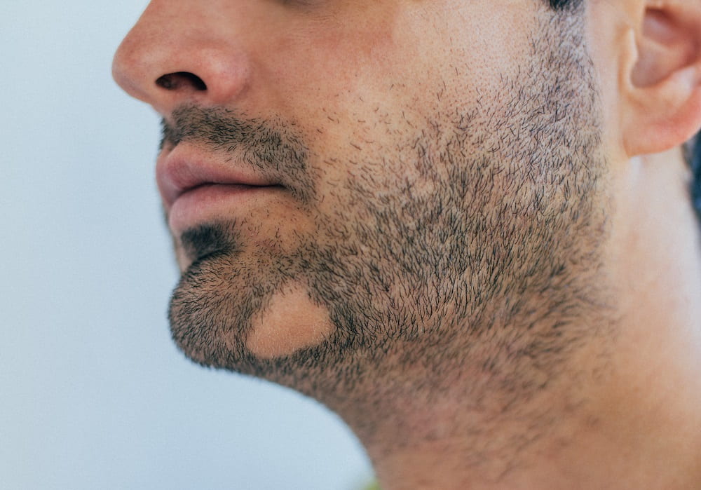 Alopecia areata in beard