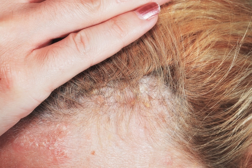 Causes scalp itching after hair dyeing - allergy