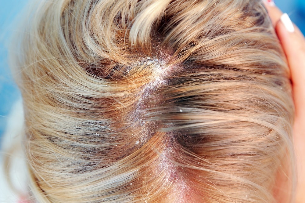 Causes of Scalp Itch After Coloring Hair - Dry Scalp