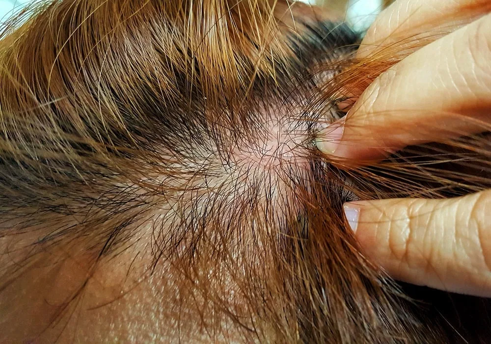 Is Your Hair Dye Causing an Allergic Reaction?