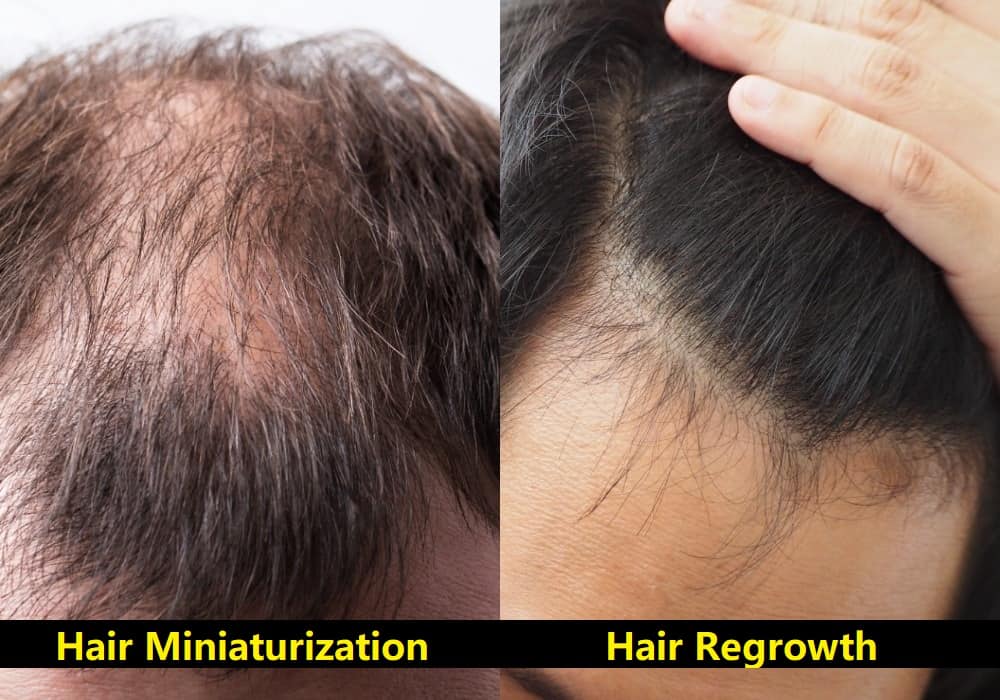 Hair Miniaturization – Signs & Non-Surgical Solution
