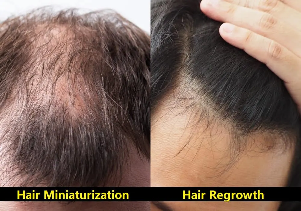Hair Miniaturization or Regrowth