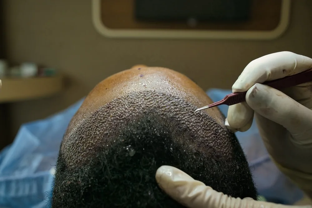 How To Hide Thinning Hair in the Front for Men - Hair Transplant