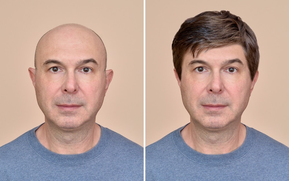 How To Hide Thinning Hair in the Front for Men - Wigs or Toupee