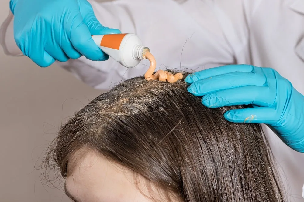How To Treat Weeping Scalp