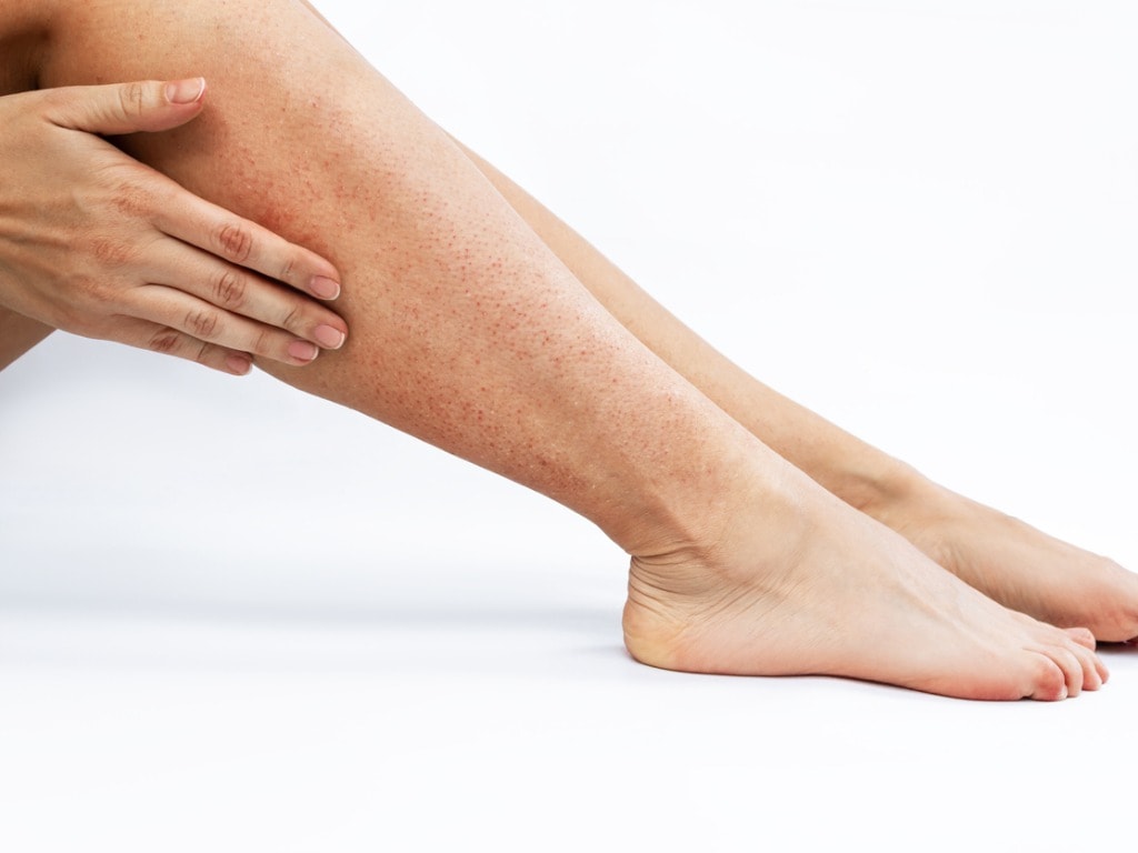 how to heal waxed skin