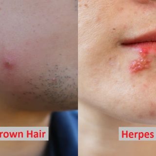 difference between ingrown hair and herpes