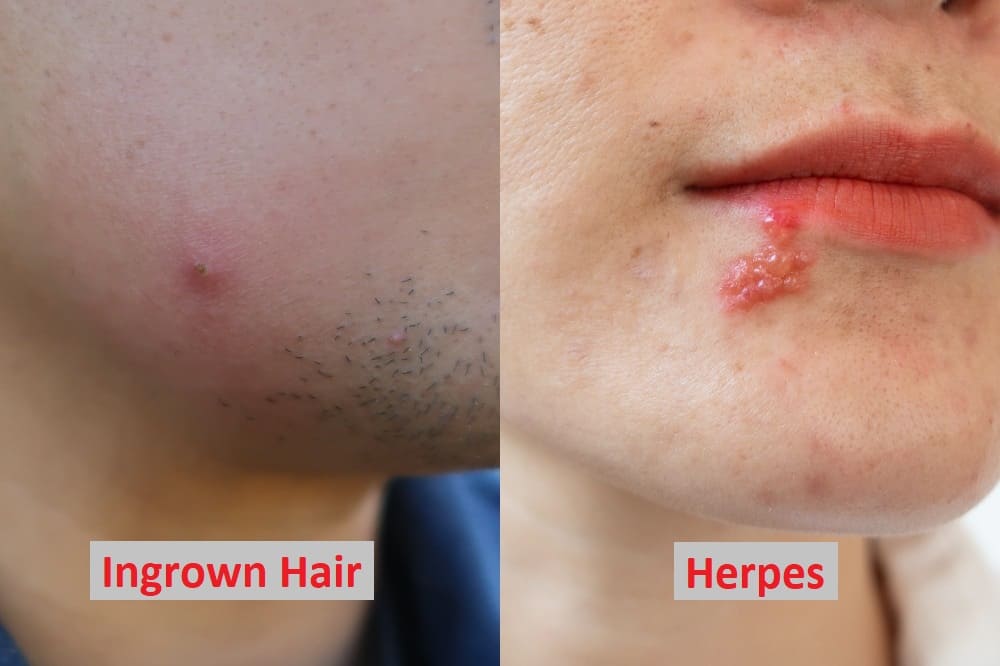 Ingrown Hair Or Herpes Differences Symptoms  Treatment