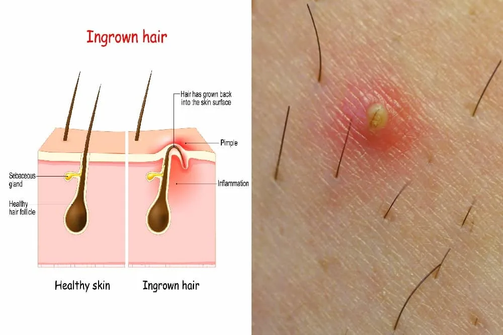 Ingrown Hair Vs. Herpes: What Are The Differences? – HairstyleCamp