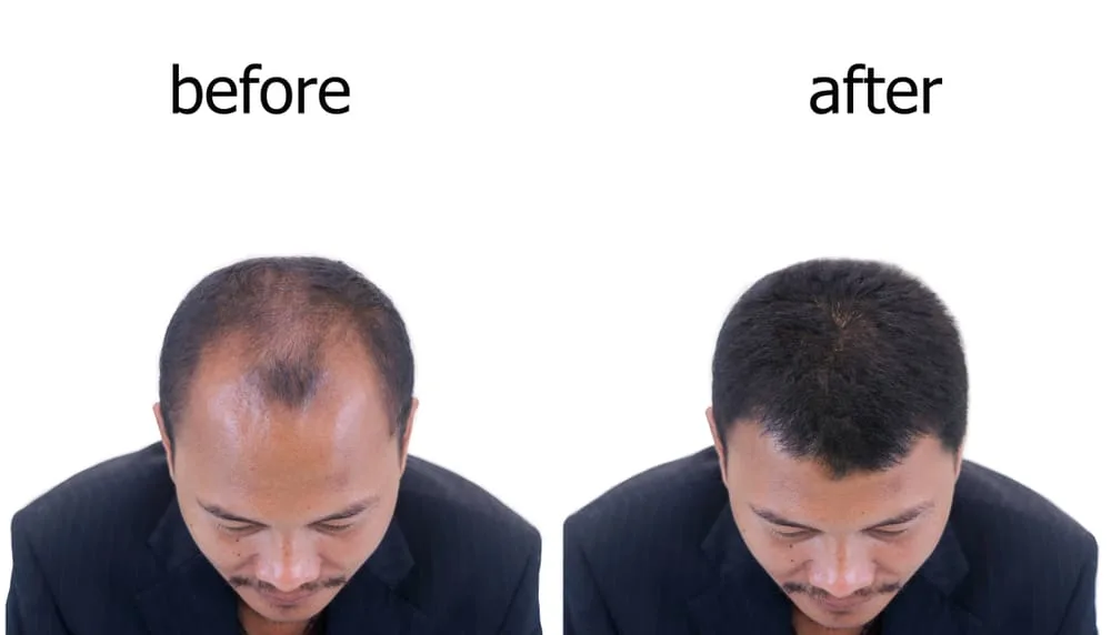 Low Level Laser Therapy for Hair Loss