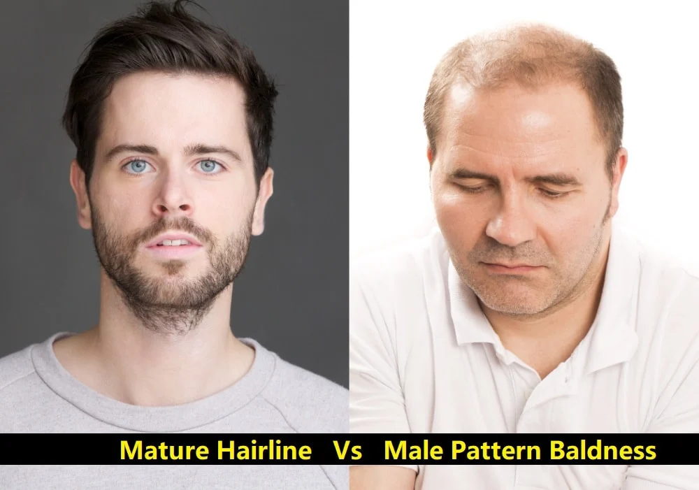 Mature Hairline vs. Male Pattern Baldness