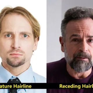 Differences Between Mature and Receding Hairlines