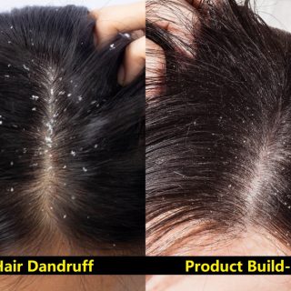 Difference Between Product Build-Up in Hair and Dandruff