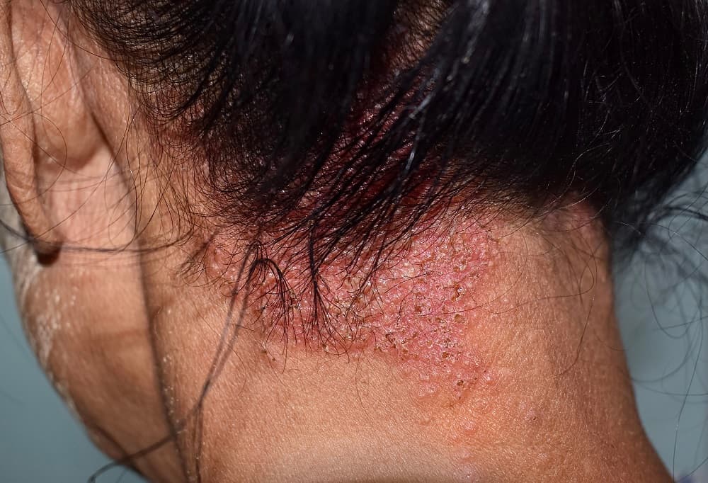 Reasons Why Hair Hurts - Seborrheic dermatitis