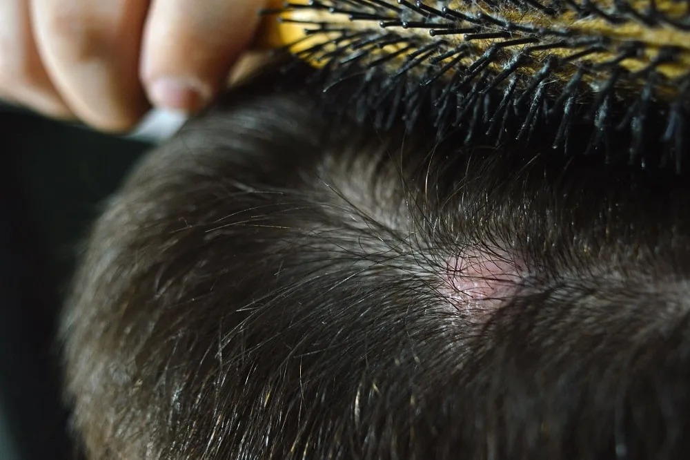 Reasons of Weeping Scalp - Cyst