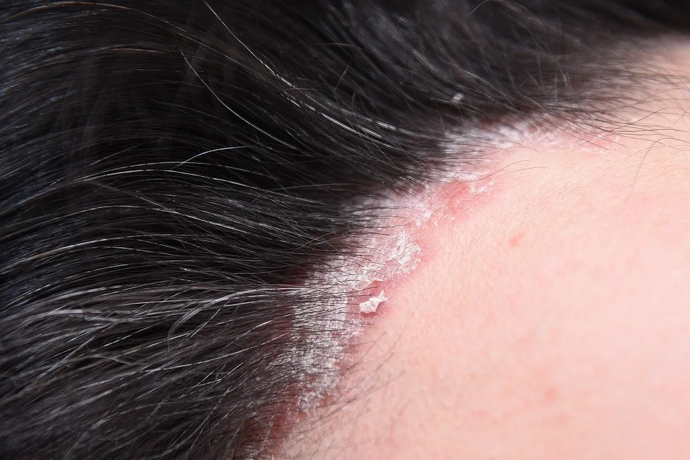 Reasons of Weeping Scalp - Scalp Psoriasis