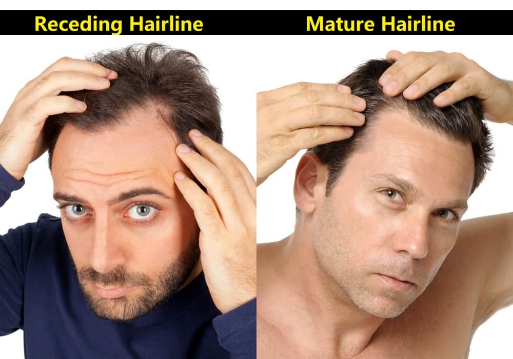 Receding Hairline vs. Mature Hairline