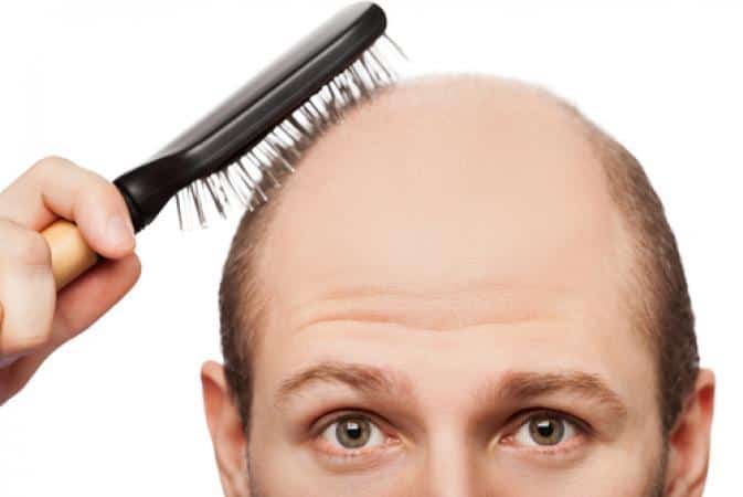 Signs Of Receding Hairline