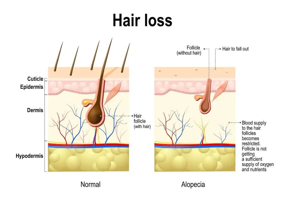Types of Hair Loss