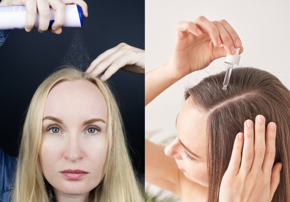 What To Do if You Have Thinning Hair in the Front
