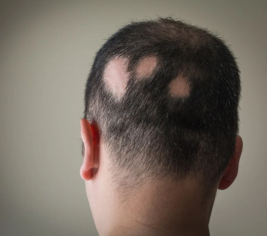 bald spots