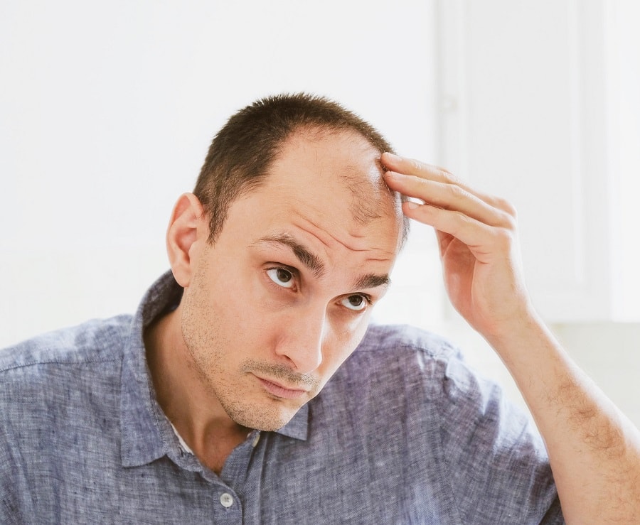 causes of balding hair in men