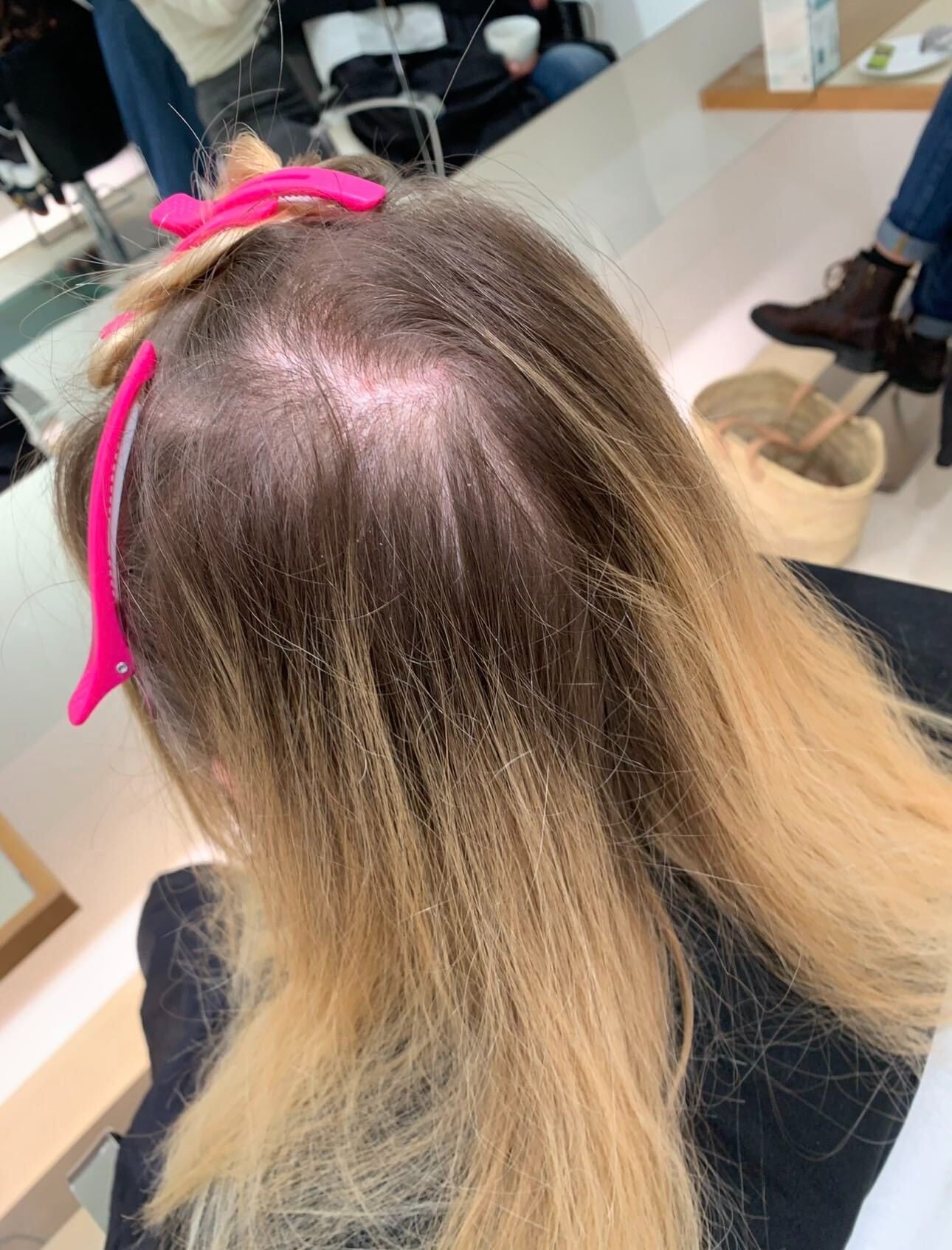 Top-down view of a client&rsquo;s crown with fine blonde hair sectioned away in pink clips, showing how much scalp is visible