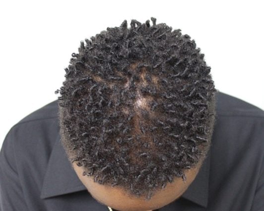 Top of head showing early central centrifugal cicatricial alopecia thinning outward from the crown