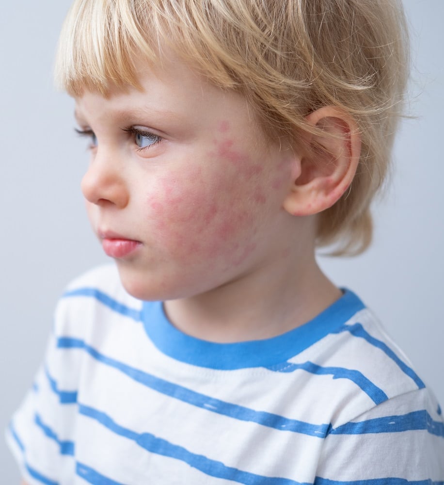 Effects of hair color on children - allergy