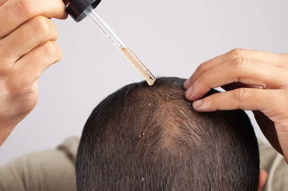 fluocinonide alternative for hair loss