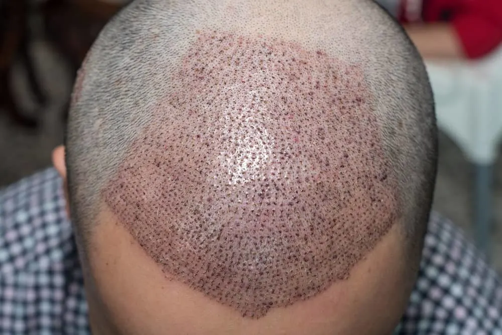 hair trasnplant to prevent receding hairline