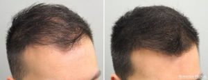 Receding Hairline: Signs & Treatment – HairstyleCamp