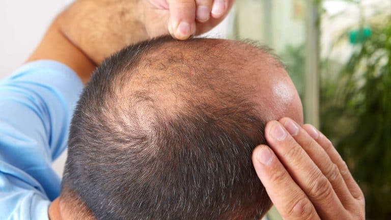 How to Hide Bald Spots