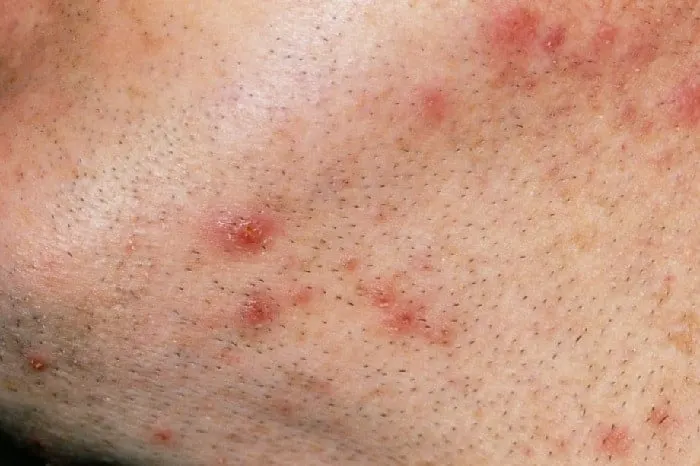 facts about ingrown hair