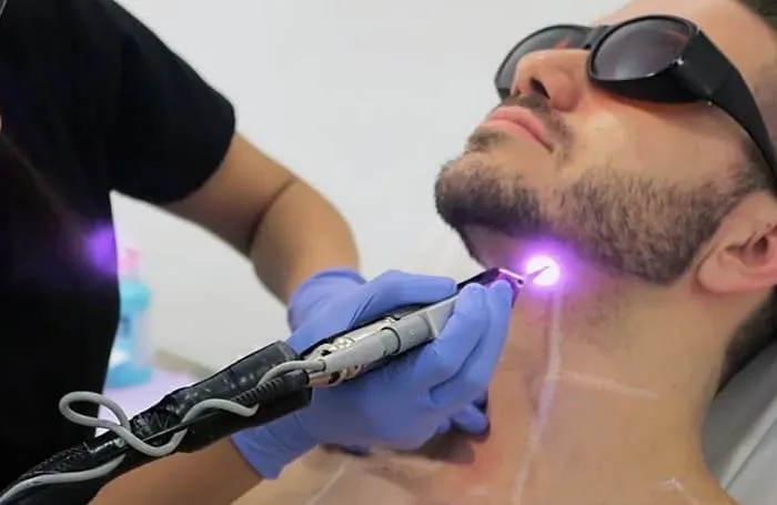laser treatment for ingrown beard hair