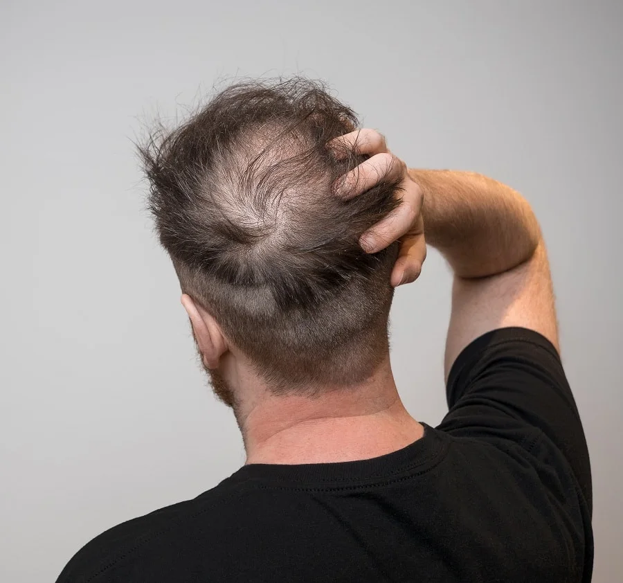 man with thinning hair