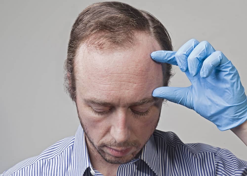 men's receding hairline