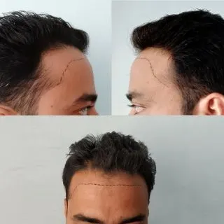 messed up hairline