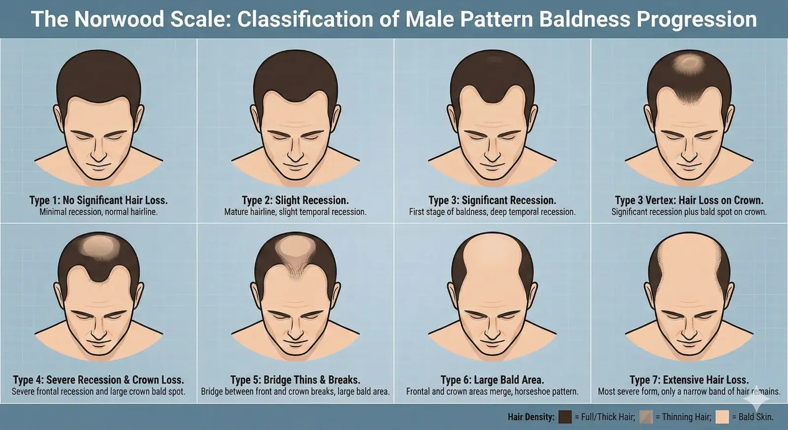 Norwood scale chart showing male pattern baldness stages from Type 1 to Type 7, including temple recession and crown thinning.