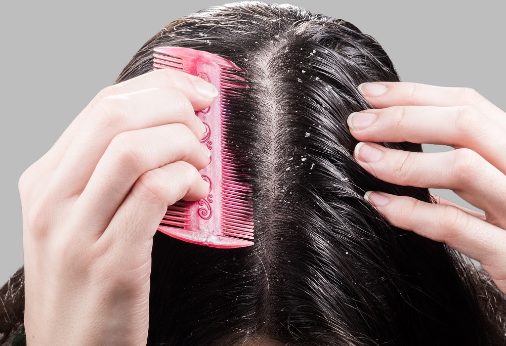 Product Build Up In Hair Vs Dandruff How To Tell The Difference