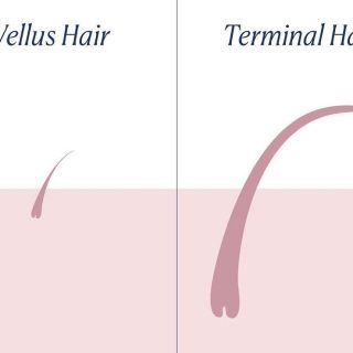 terminal hair vs vellus hair