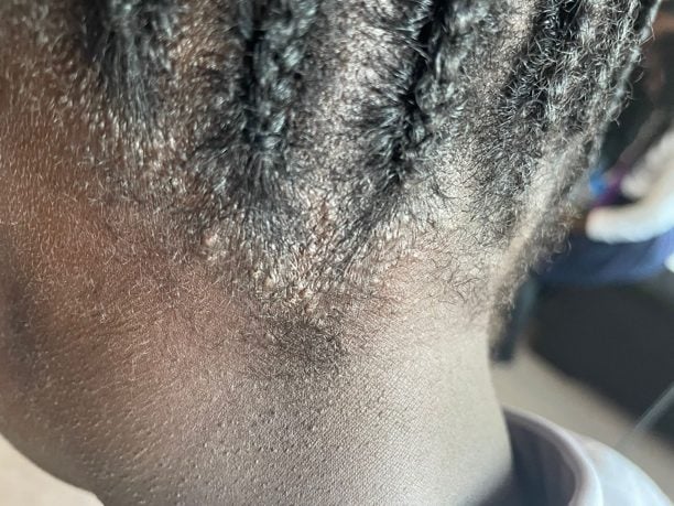 Close-up of nape showing tight braiding pulling on the hairline and the resulting tension damage