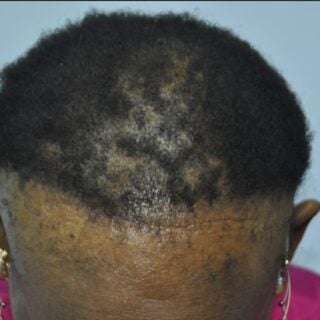 Crown and hairline of Black woman showing traction alopecia with central centrifugal cicatricial alopecia