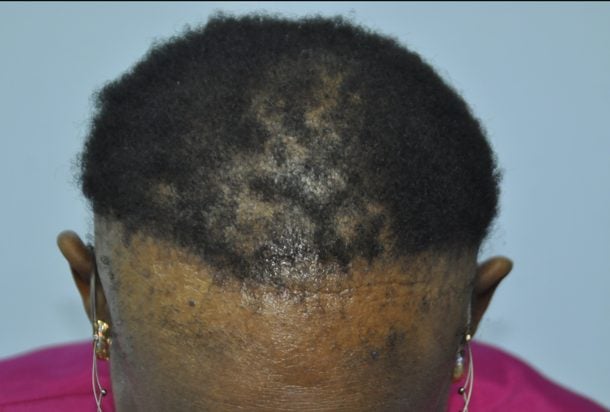 Crown and hairline of Black woman showing traction alopecia with central centrifugal cicatricial alopecia