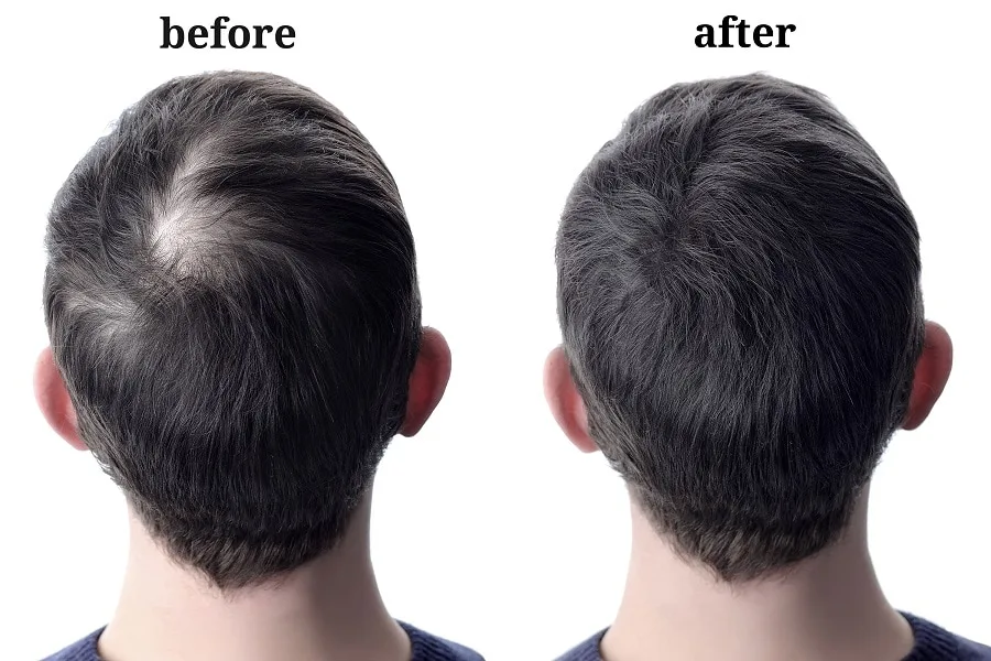 ways to reverse balding hair in men