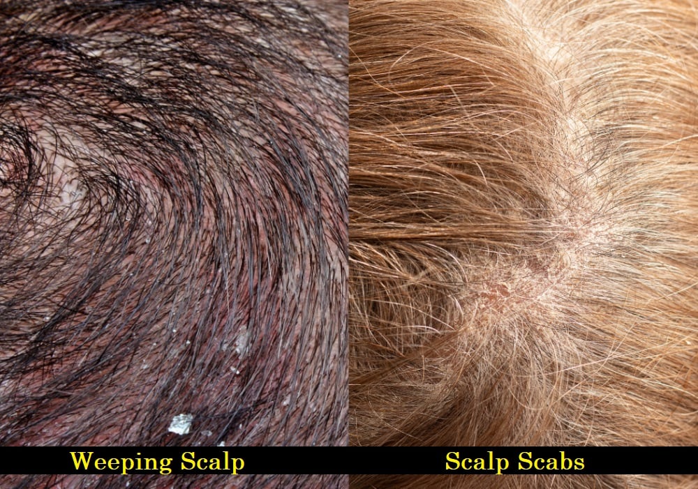 Is Weeping Scalp and Scalp Scabs the Same Thing?