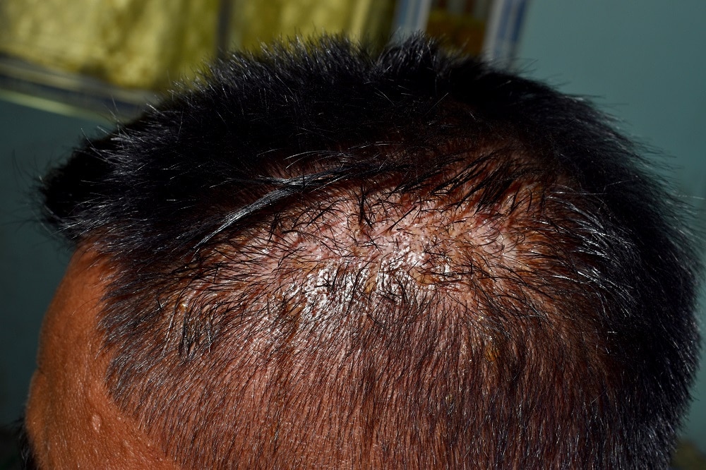 What Is Weeping Scalp?